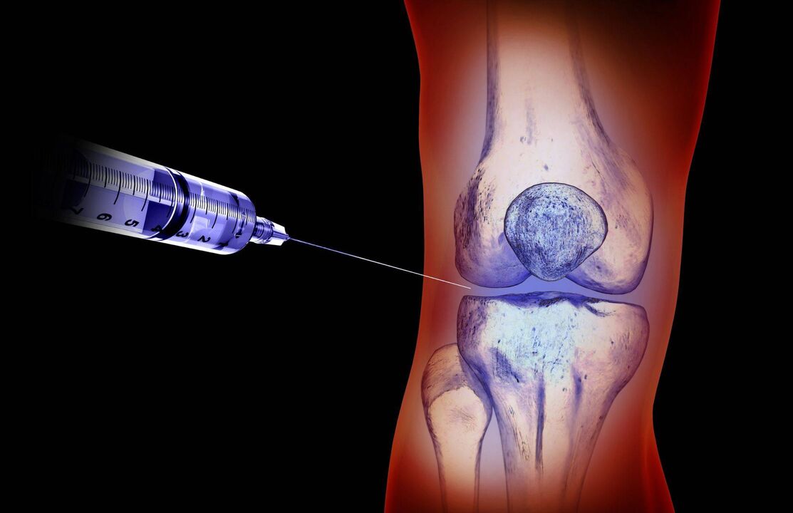 injection intra-articulaire pour l'arthrose