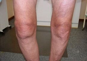 Comment traiter l'arthrose articulaire du genou
