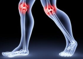 Raison - Développement sécable de l'arthrose du genou