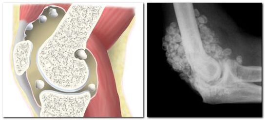chondromatose avec douleur dans l'articulation de la hanche