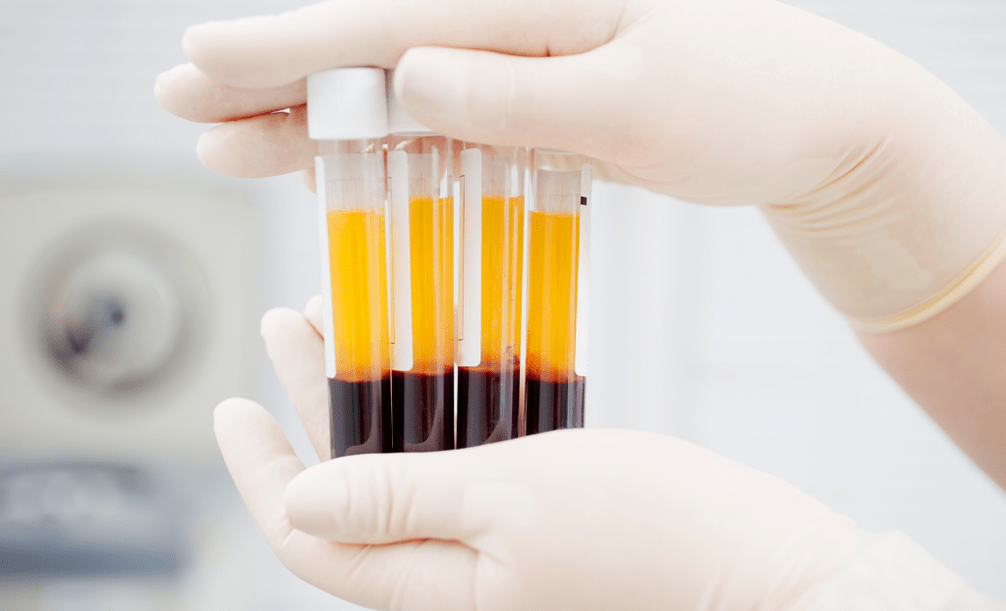 Plasma riche en plaquettes pour le traitement PRP de l'arthrose